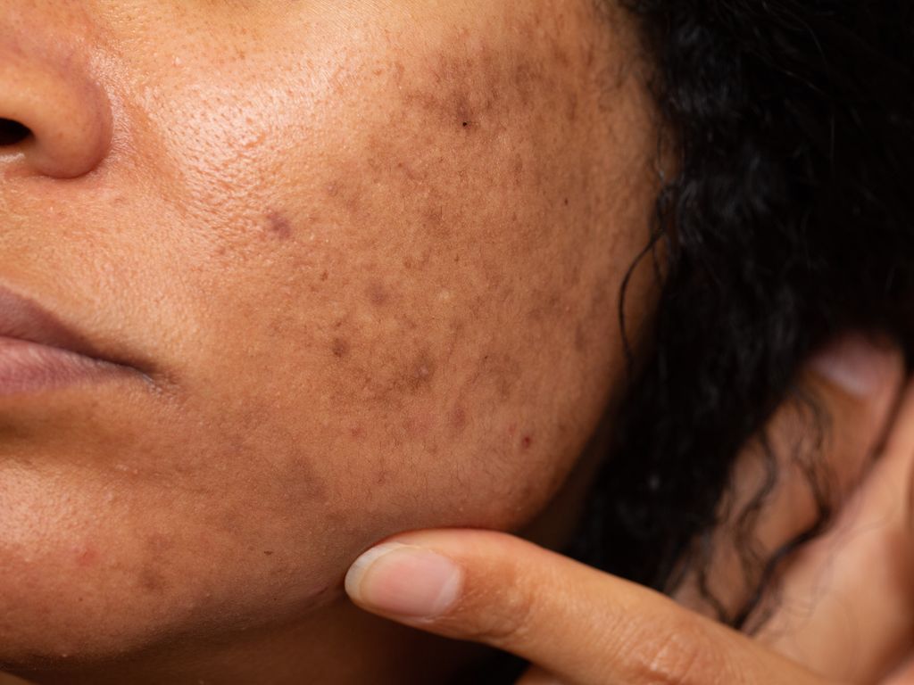 6 Skin-Care Mistakes That Are Making Your Dark Spots Worse